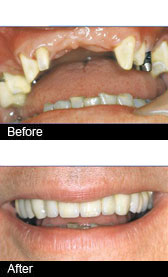 Photo of a dental bridge, used as a way to replace multiple teeth in a patient