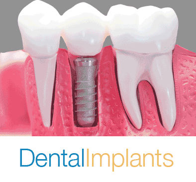 Dental Implants Testimonials