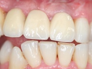Dental Implants being used to replace the missing teeth in the dental implant patient