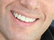 The patients final smile after dental implant placement