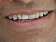 The patients final smile after a dental implant has been used to replace their missing tooth