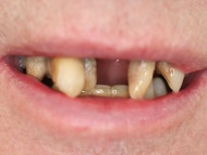 A dental implant patient before any treatment