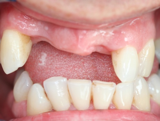 dental implant case 1 photo 1 of 3