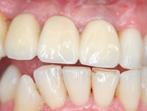dental implant case 1 photo 2 of 3