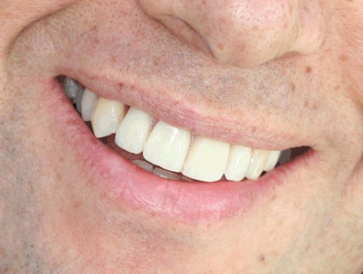 dental implant case 1 photo 3 of 3
