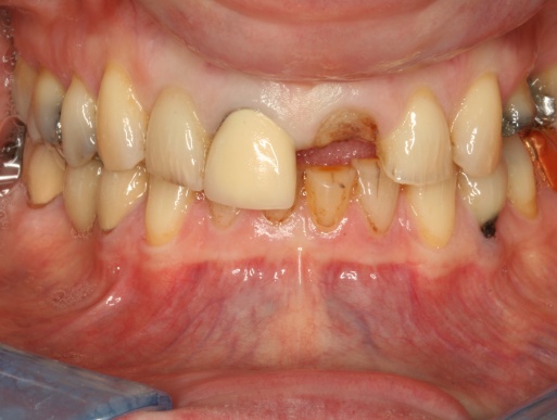 dental implant case 2 photo 1 of 3