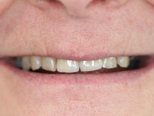 dental implant case 2 photo 3 of 3