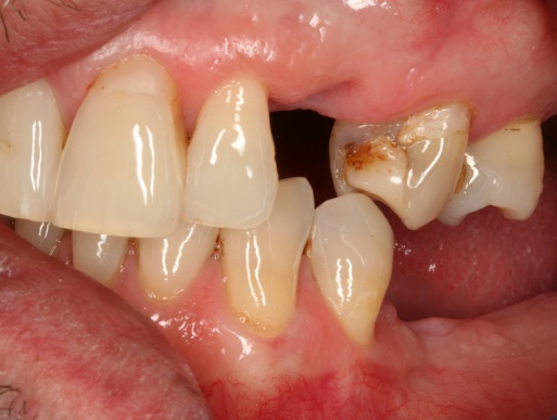 dental implant case 3 photo 1 of 4