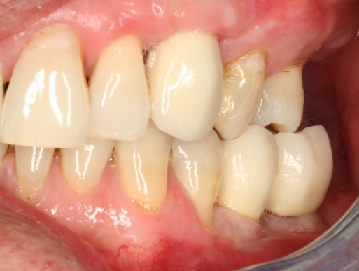 dental implant case 3 photo 2 of 4