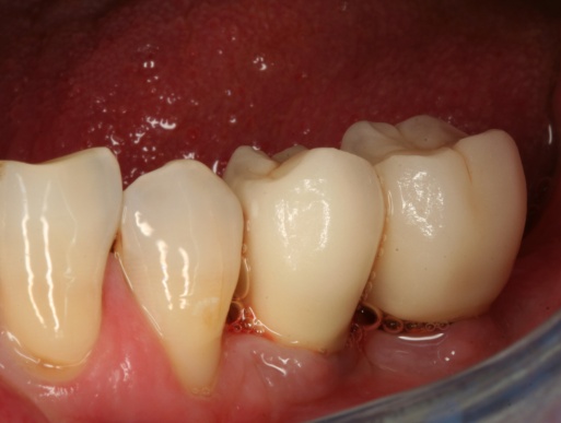 dental implant case 3 photo 3 of 4