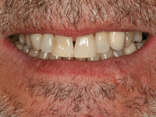 dental implant case 3 photo 4 of 4