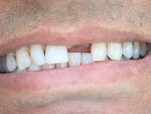 dental implant case 8 photo 1 of 4