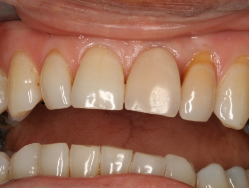 dental implant case 8 photo 3 of 4