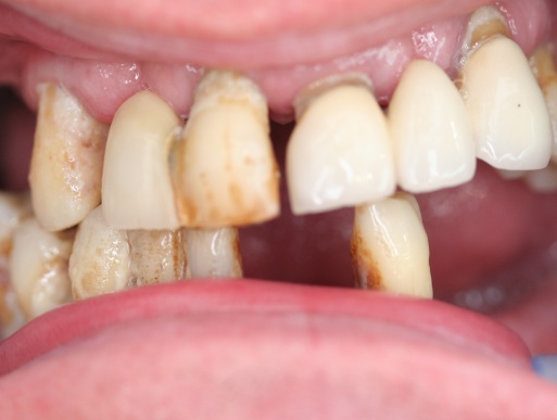 dental implant case 4 photo 1 of 4