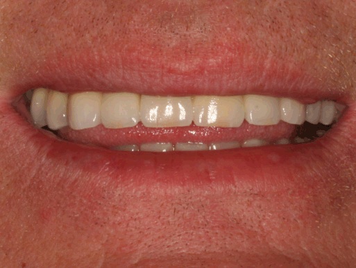 dental implant case 4 photo 4 of 4