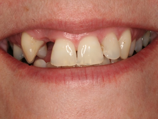 dental implant case 2 photo 1 of 2