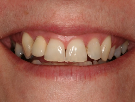 dental implant case 2 photo 2 of 2