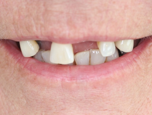 dental implant case 6 photo 1 of 3
