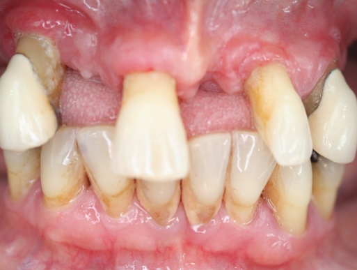 dental implant case 6 photo 2 of 3