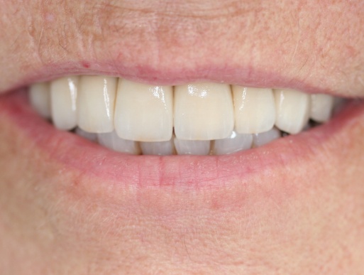 dental implant case 6 photo 3 of 3