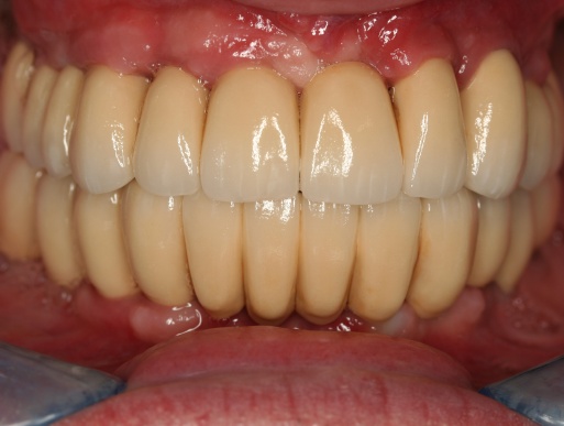 dental implant case 7 photo 3 of 4