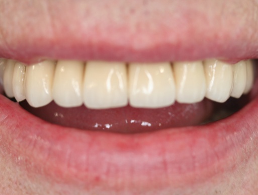 dental implant case 7 photo 4 of 4
