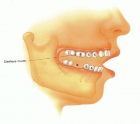 Image where one of the patients teeth is missing (lower 6)