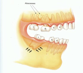 The movement of the upper 6 tooth causes the lower 7 tooth to tilt forward which results in gum problems for the patient