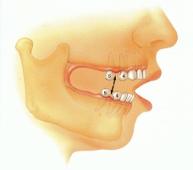 Root Canal Treatment Birmingham at our Birmingham Dentists