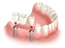 implant supported bridgework from £4720