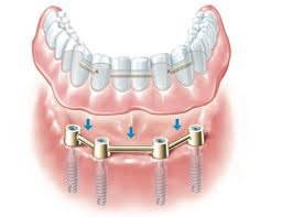 denture stabilisation from £3950 - £7900