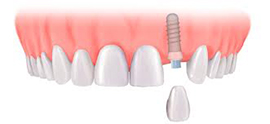 single implant and crown for £2035 - £2472