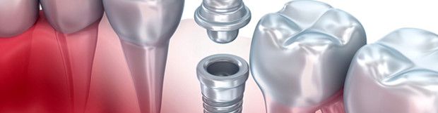 What are the benefits of implants?