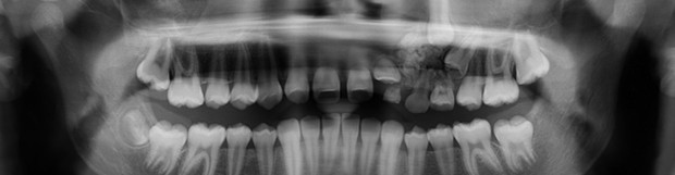 What is a compound odontoma?